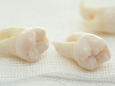 智齒疼了，這牙非拔不可嗎？