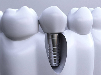 承德種植牙價(jià)格表，2024種植牙多少錢(qián)一顆呢?