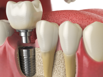 選擇種植牙后要做哪些日常維護(hù)？