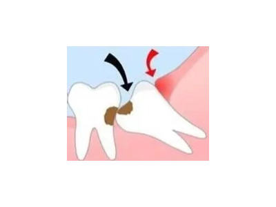 吃完飯后老塞牙？別大意！這可能是你的牙齒在報警