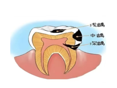 乳牙不是 “過渡品”——保護(hù)孩子牙齒從第一顆開始