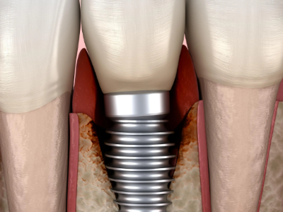 種植牙的術(shù)前準(zhǔn)備有哪些？