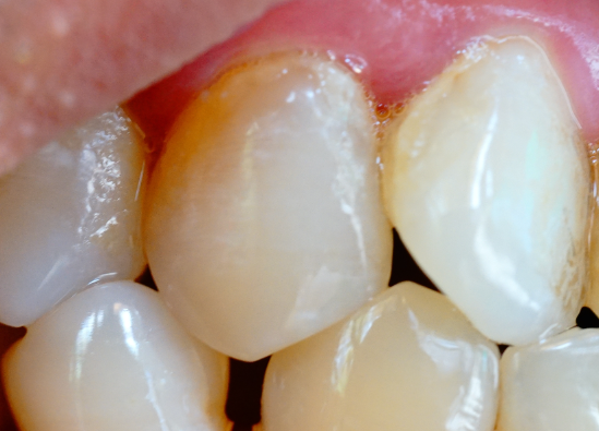 牙齒表面的牙釉質(zhì)掉了還可以修復(fù)嗎？