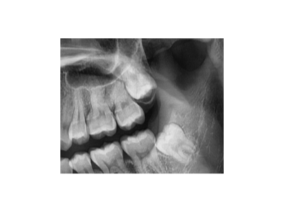 既然「智齒」不宜久留，為什么不能一次性拔掉？