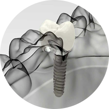 術(shù)前研究、模擬提升種植成功率