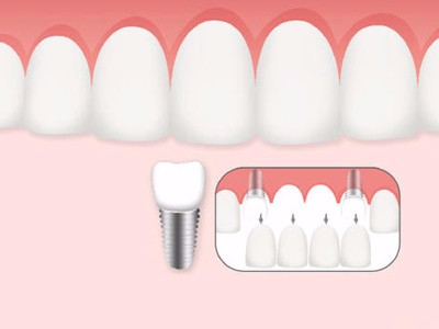 惟德口腔口腔種植怎么樣？惟德口腔就來為您一一解答