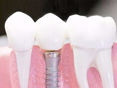 在承德口腔種植齒需要多少錢？惟德口腔一一為您道來(lái)