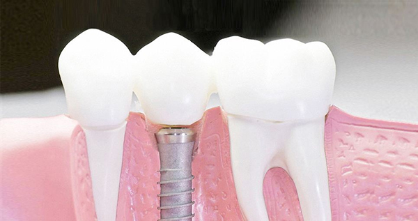 在承德口腔種植牙齒需要多少錢？惟德口腔一一為您道來