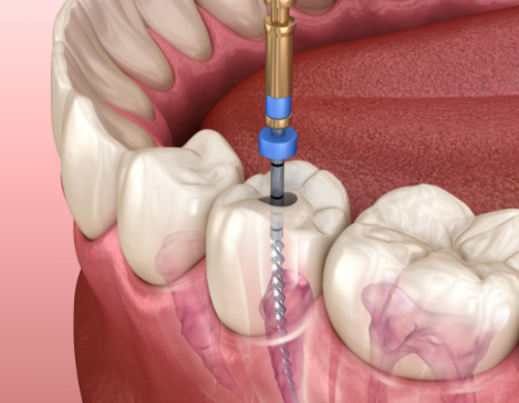 根管治療后的注意事項(xiàng)有哪些？